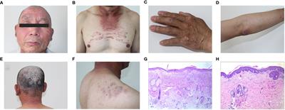 Concurrence of dermatomyositis and psoriasis: a case report and literature review